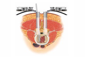 Minimally Invasive Spine Surgery